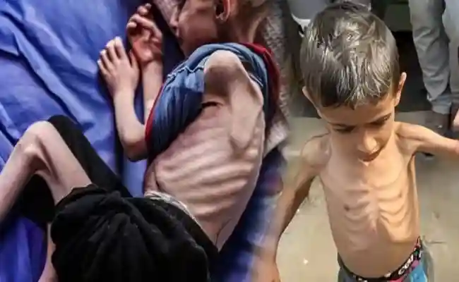 গাজায় ক্ষুধা ও অপুষ্টির কারণে শহীদের সংখ্যা বেড়ে ৪০০-1 copy